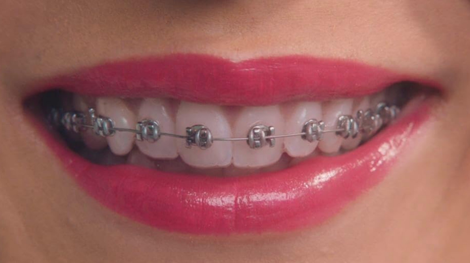 A close up of braces on a woman's teeth in 'Greener Grass' (2019); 6 Keys to Writing a Short Script